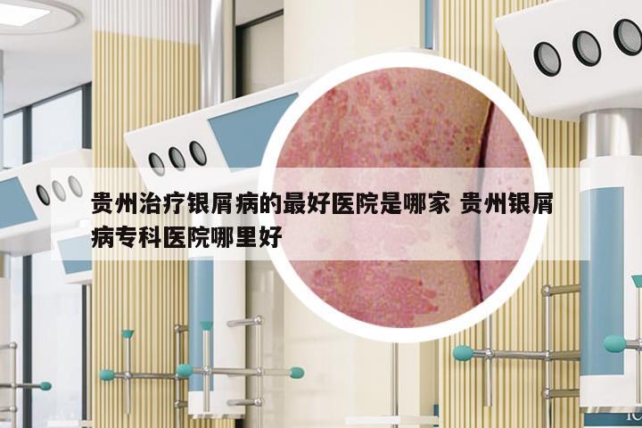 贵州治疗银屑病的最好医院是哪家 贵州银屑病专科医院哪里好