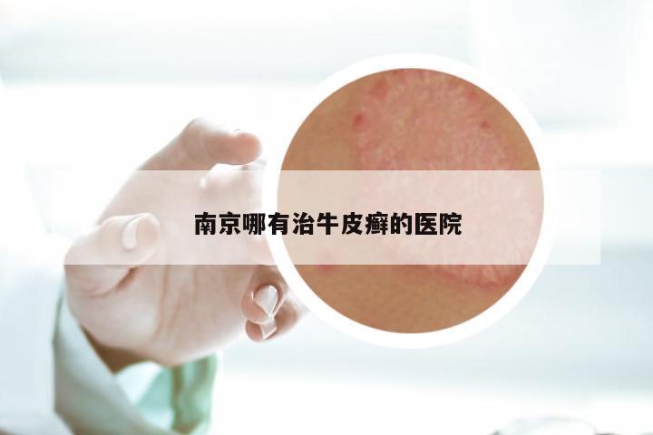 南京哪有治牛皮癣的医院