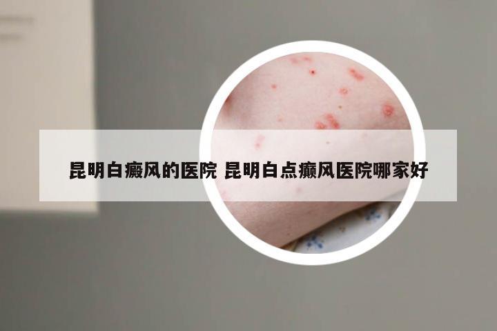 昆明白癜风的医院 昆明白点癫风医院哪家好