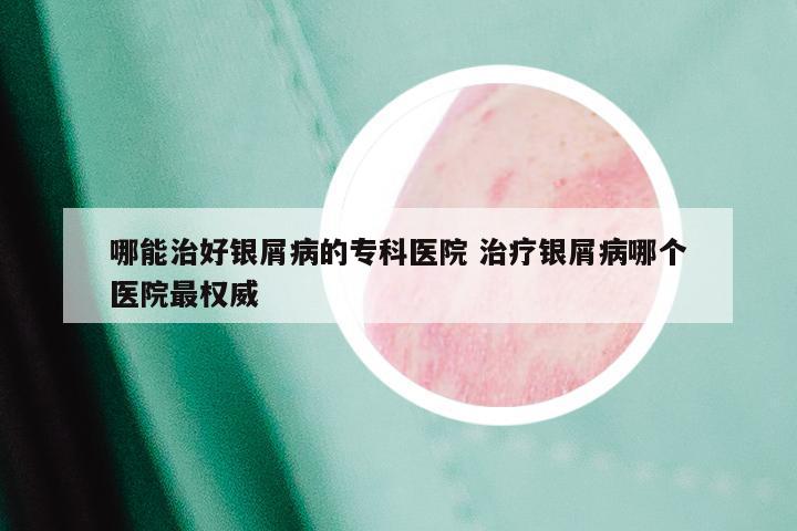 哪能治好银屑病的专科医院 治疗银屑病哪个医院最权威