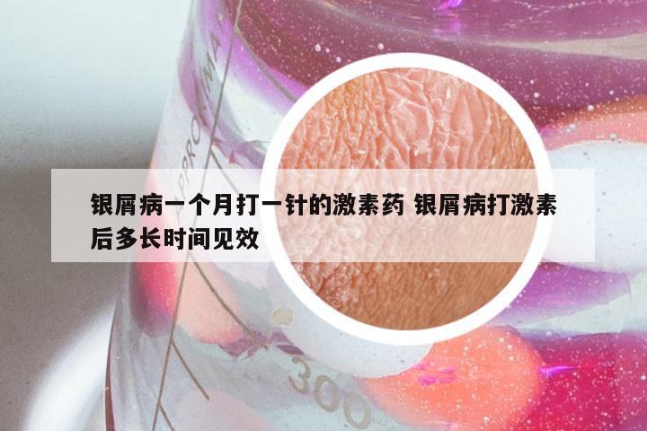 银屑病一个月打一针的激素药 银屑病打激素后多长时间见效