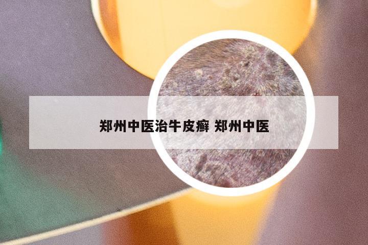 郑州中医治牛皮癣 郑州中医
