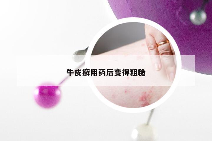牛皮癣用药后变得粗糙