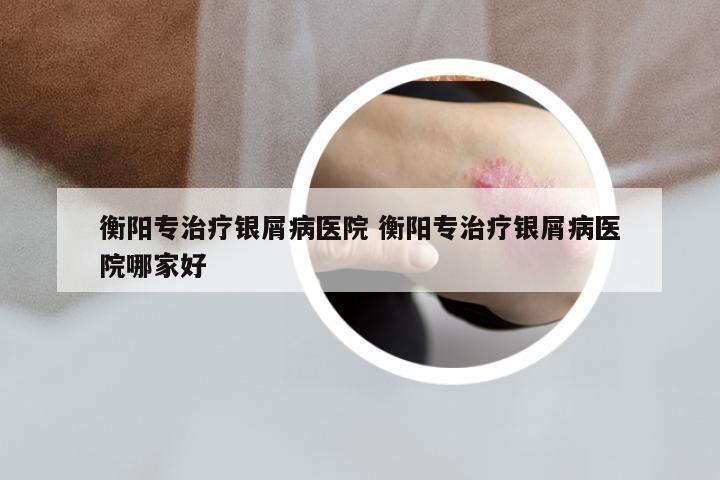 衡阳专治疗银屑病医院 衡阳专治疗银屑病医院哪家好