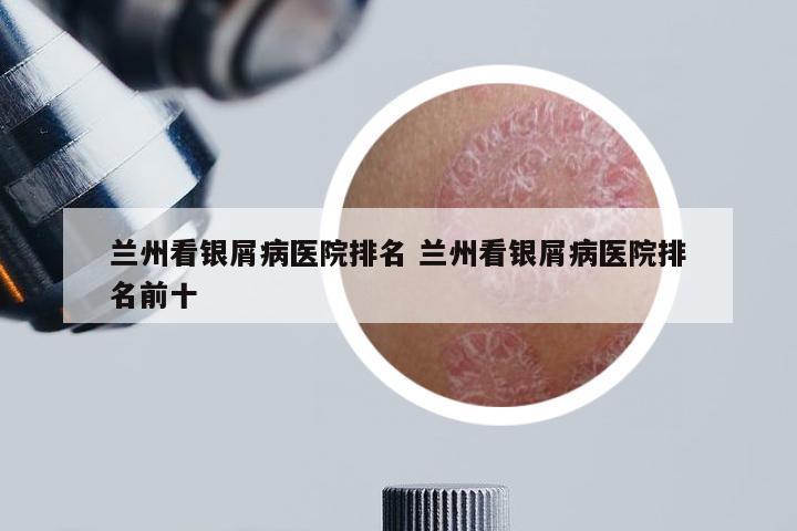 兰州看银屑病医院排名 兰州看银屑病医院排名前十