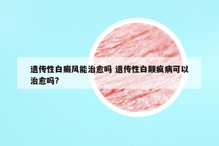 遗传性白癜风能治愈吗 遗传性白颠疯病可以治愈吗?