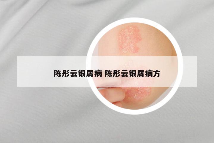 陈彤云银屑病 陈彤云银屑病方