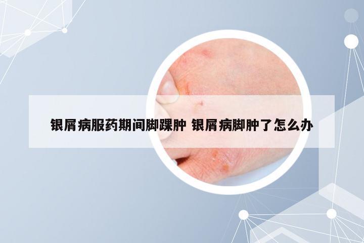 银屑病服药期间脚踝肿 银屑病脚肿了怎么办