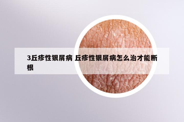3丘疹性银屑病 丘疹性银屑病怎么治才能断根