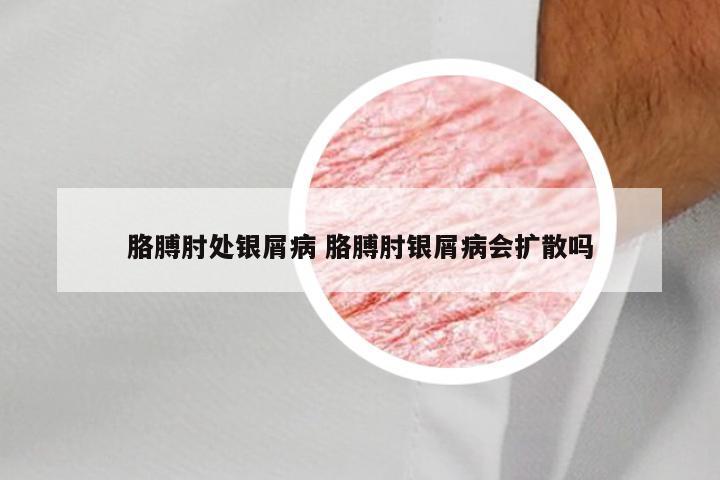 胳膊肘处银屑病 胳膊肘银屑病会扩散吗