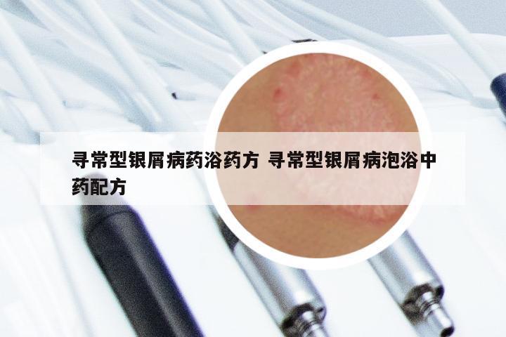 寻常型银屑病药浴药方 寻常型银屑病泡浴中药配方