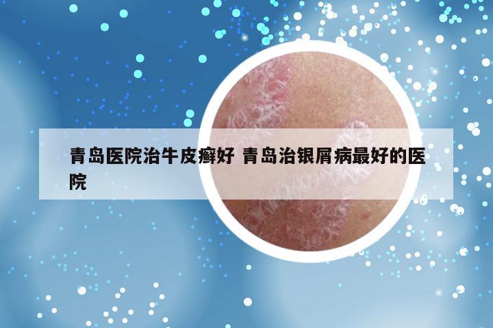 青岛医院治牛皮癣好 青岛治银屑病最好的医院