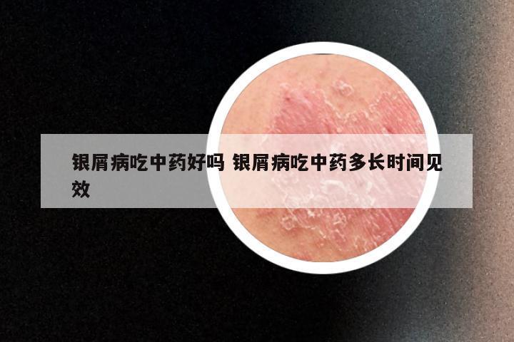 银屑病吃中药好吗 银屑病吃中药多长时间见效