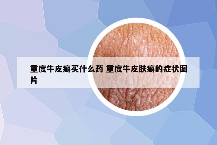重度牛皮癣买什么药 重度牛皮肤癣的症状图片