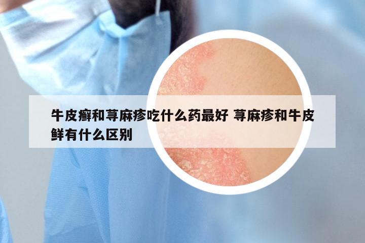 牛皮癣和荨麻疹吃什么药最好 荨麻疹和牛皮鲜有什么区别