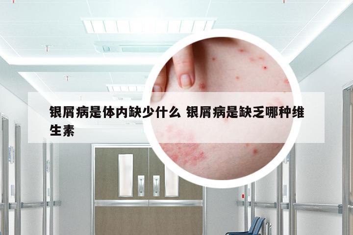 银屑病是体内缺少什么 银屑病是缺乏哪种维生素