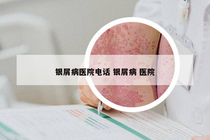 银屑病医院电话 银屑病 医院