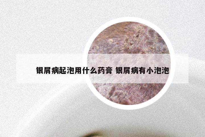 银屑病起泡用什么药膏 银屑病有小泡泡