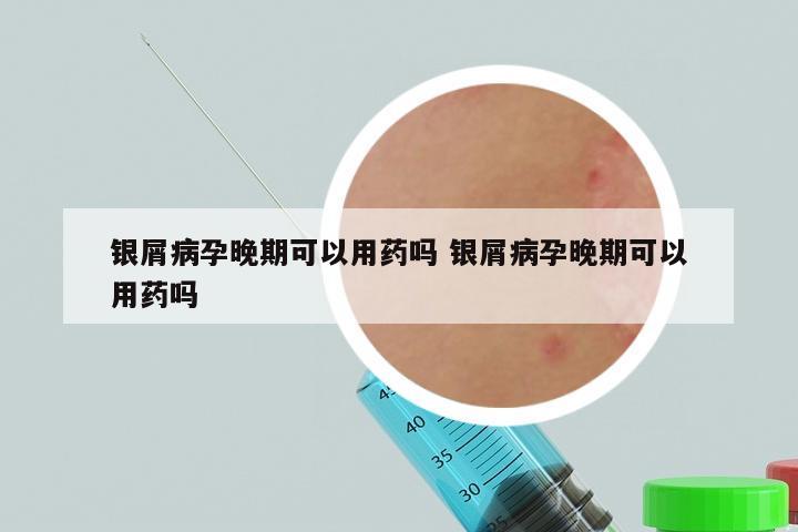 银屑病孕晚期可以用药吗 银屑病孕晚期可以用药吗