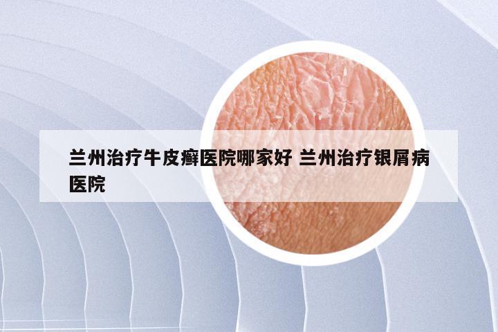 兰州治疗牛皮癣医院哪家好 兰州治疗银屑病医院