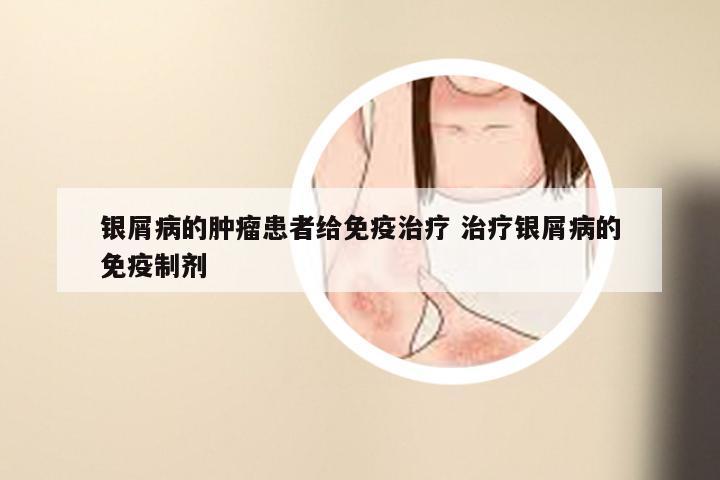 银屑病的肿瘤患者给免疫治疗 治疗银屑病的免疫制剂
