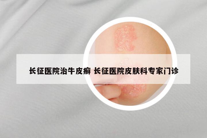 长征医院治牛皮癣 长征医院皮肤科专家门诊