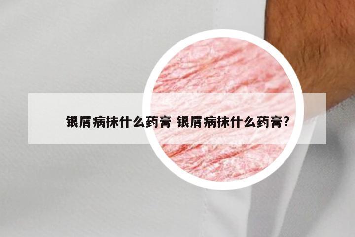 银屑病抹什么药膏 银屑病抹什么药膏?