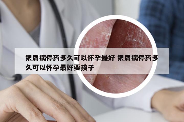银屑病停药多久可以怀孕最好 银屑病停药多久可以怀孕最好要孩子