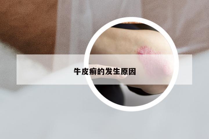 牛皮癣的发生原因