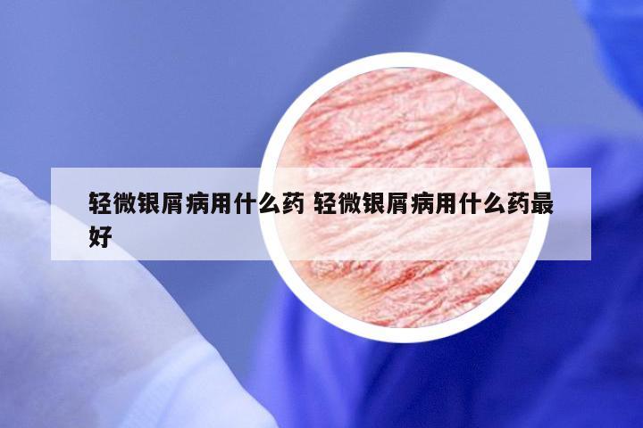轻微银屑病用什么药 轻微银屑病用什么药最好