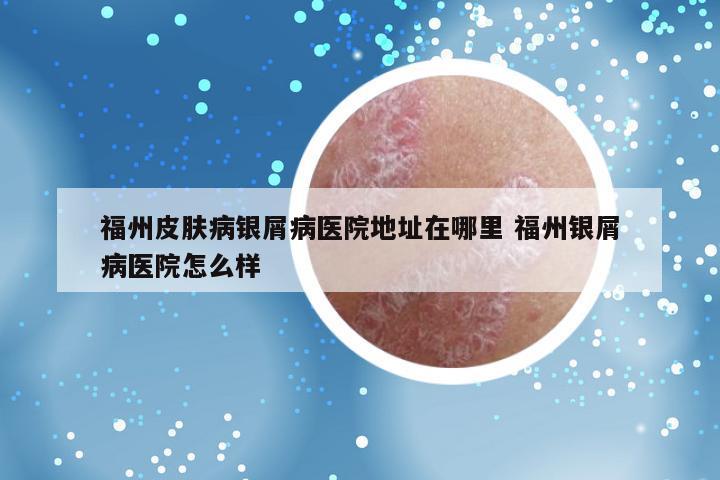 福州皮肤病银屑病医院地址在哪里 福州银屑病医院怎么样