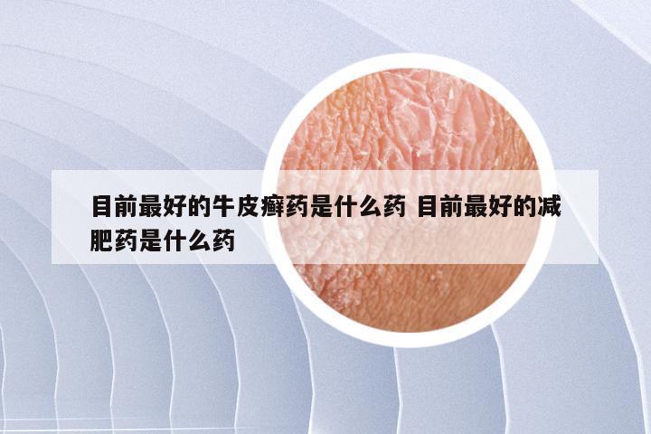 目前最好的牛皮癣药是什么药 目前最好的减肥药是什么药