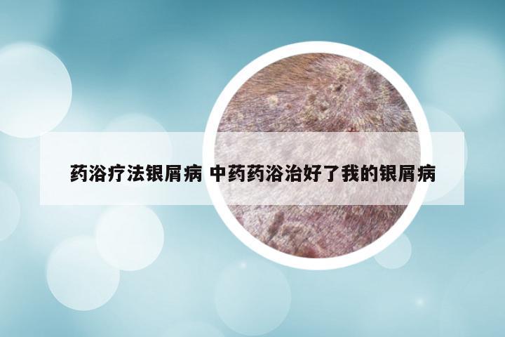 药浴疗法银屑病 中药药浴治好了我的银屑病