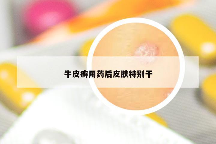 牛皮癣用药后皮肤特别干