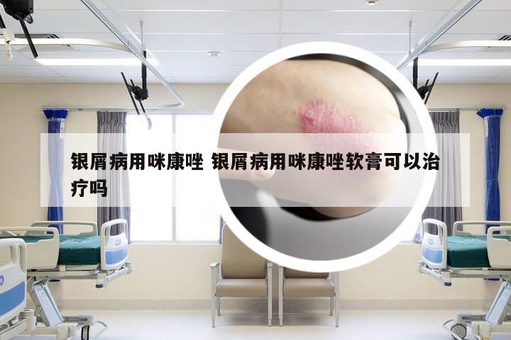 银屑病用咪康唑 银屑病用咪康唑软膏可以治疗吗