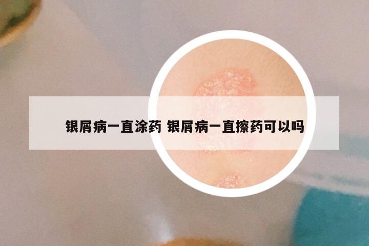 银屑病一直涂药 银屑病一直擦药可以吗