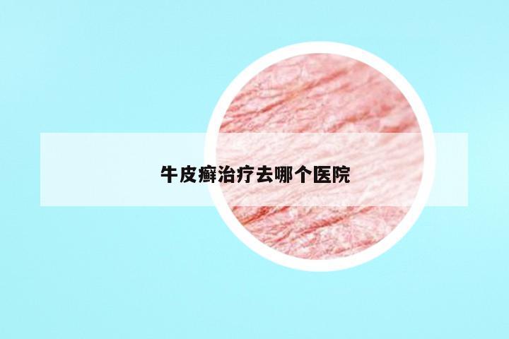 牛皮癣治疗去哪个医院
