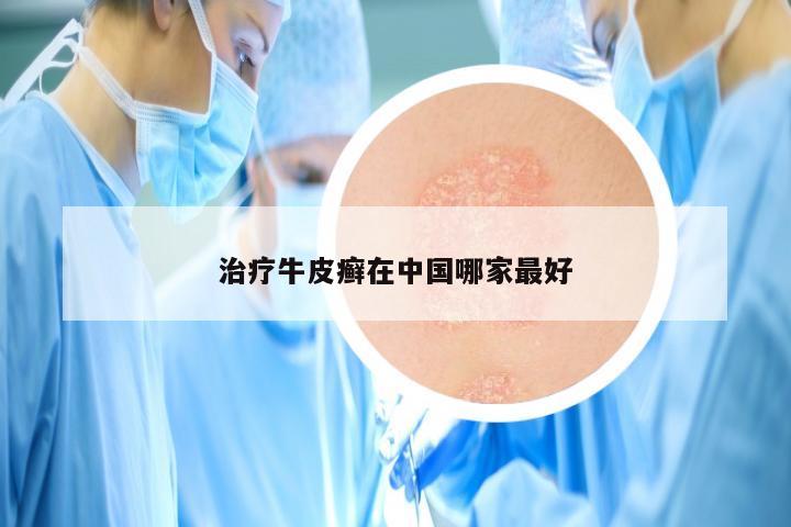 治疗牛皮癣在中国哪家最好