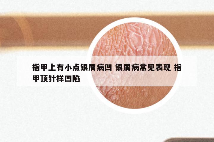 指甲上有小点银屑病凹 银屑病常见表现 指甲顶针样凹陷
