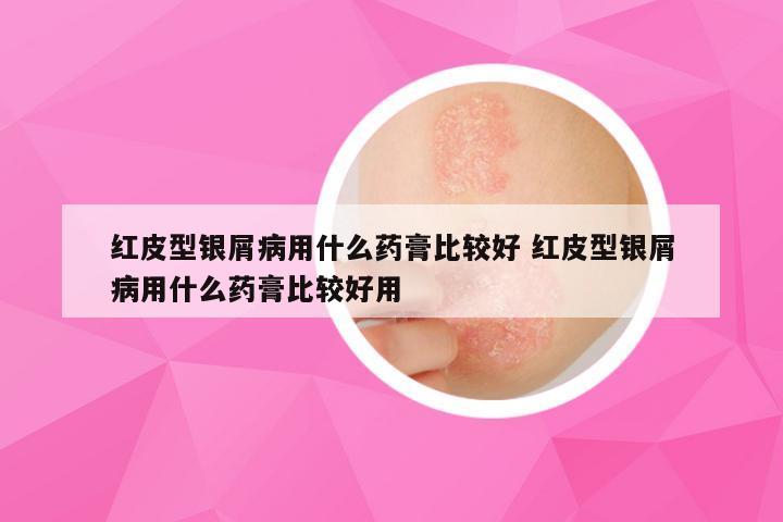 红皮型银屑病用什么药膏比较好 红皮型银屑病用什么药膏比较好用