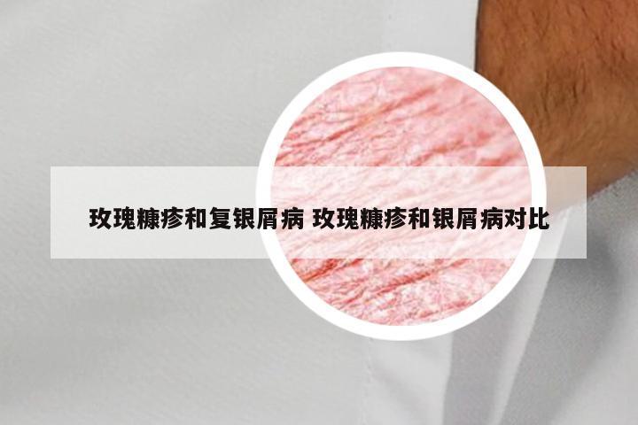 玫瑰糠疹和复银屑病 玫瑰糠疹和银屑病对比