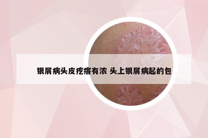 银屑病头皮疙瘩有浓 头上银屑病起的包