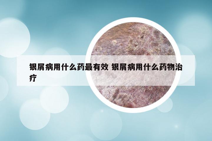 银屑病用什么药最有效 银屑病用什么药物治疗