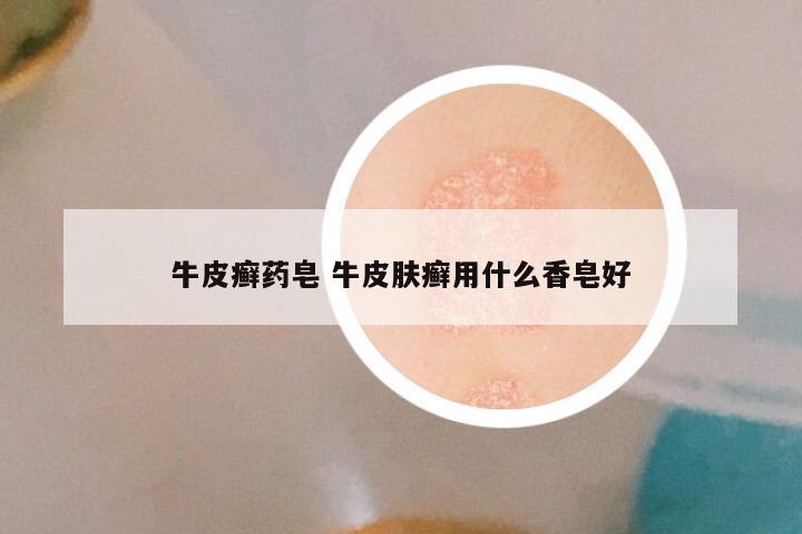 牛皮癣药皂 牛皮肤癣用什么香皂好