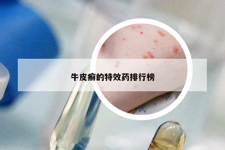 牛皮癣的特效药排行榜