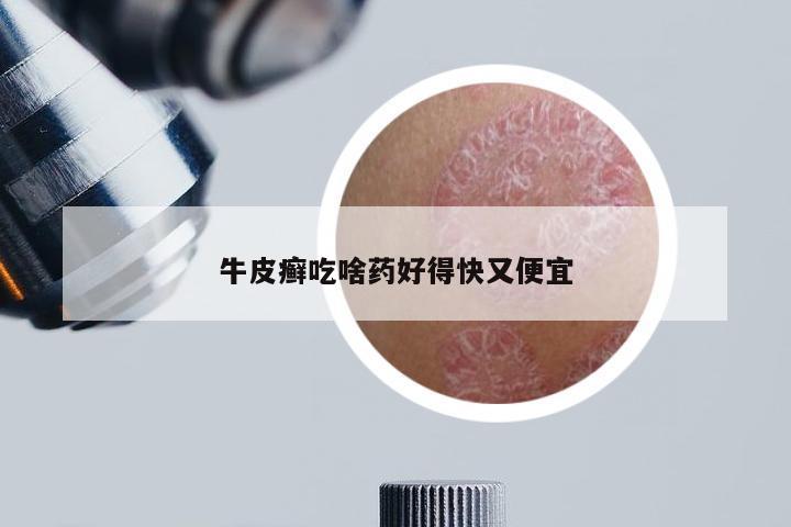 牛皮癣吃啥药好得快又便宜