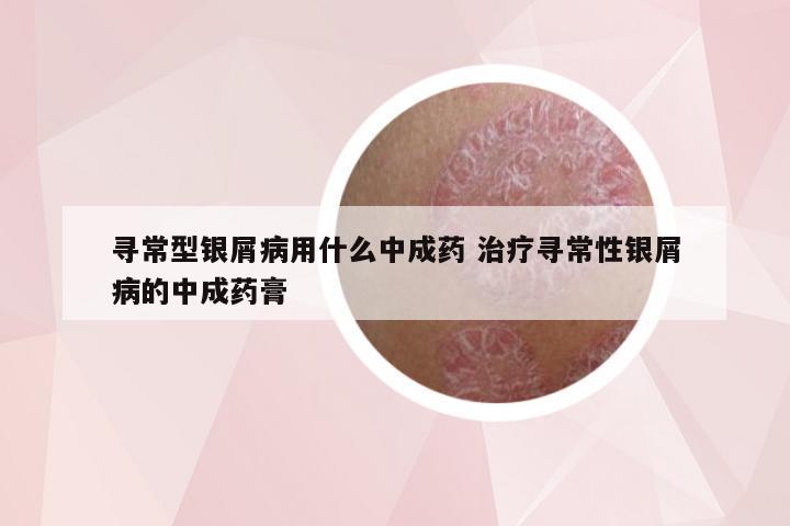 寻常型银屑病用什么中成药 治疗寻常性银屑病的中成药膏