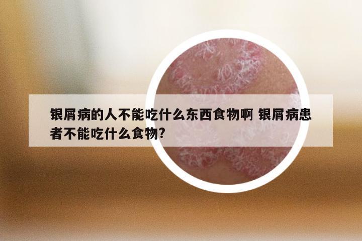 银屑病的人不能吃什么东西食物啊 银屑病患者不能吃什么食物?
