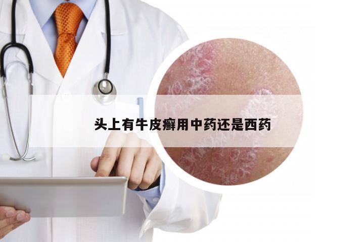 头上有牛皮癣用中药还是西药