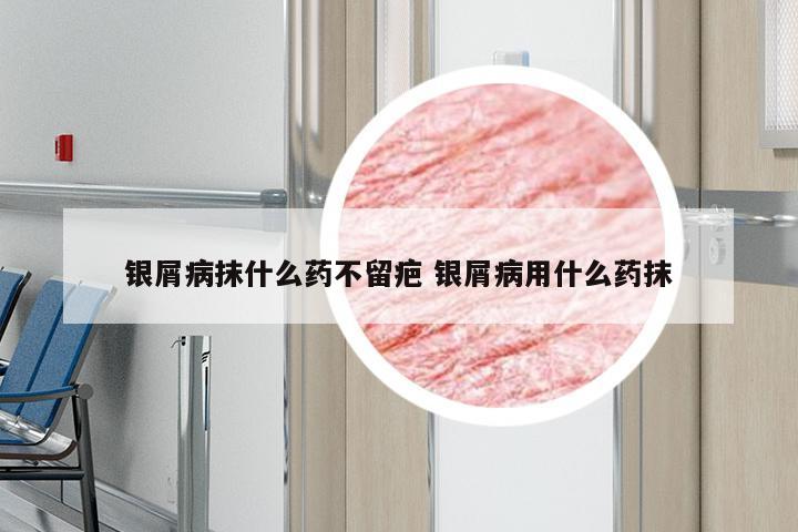 银屑病抹什么药不留疤 银屑病用什么药抹